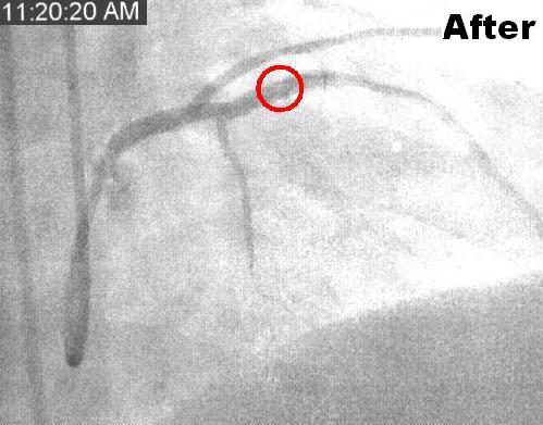 Artery after procedure